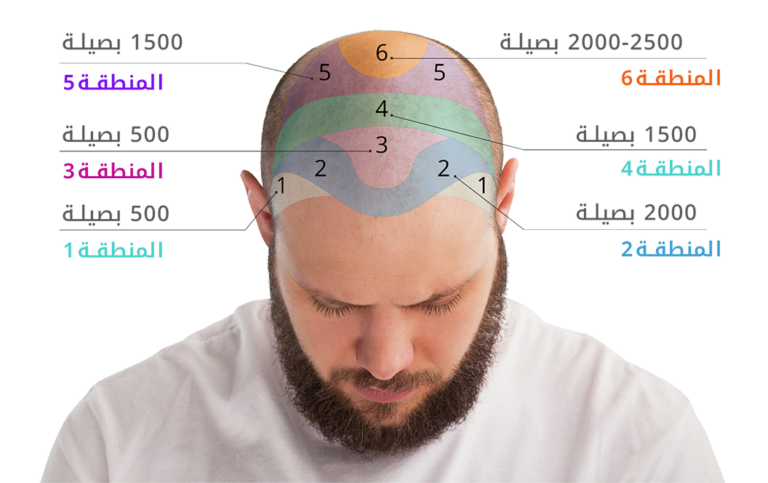 عدد بصيلات الشعر المطلوبة لكل منطقة في الرأس - مركز اليت هير لزراعة الشعر