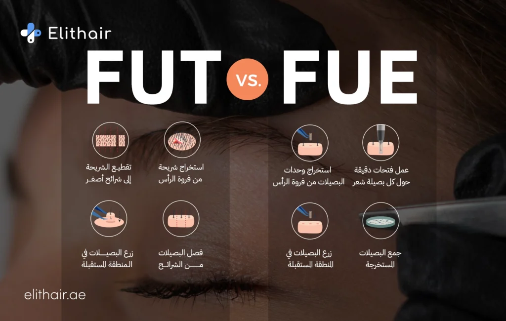 الفرق بين تقنية FUE وFUT - مركز اليت هير لزراعة الشعر