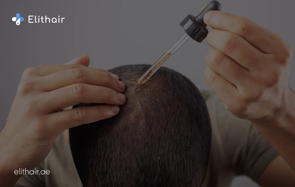 المينوكسيديل - مركز اليت هير لزراعة الشعر