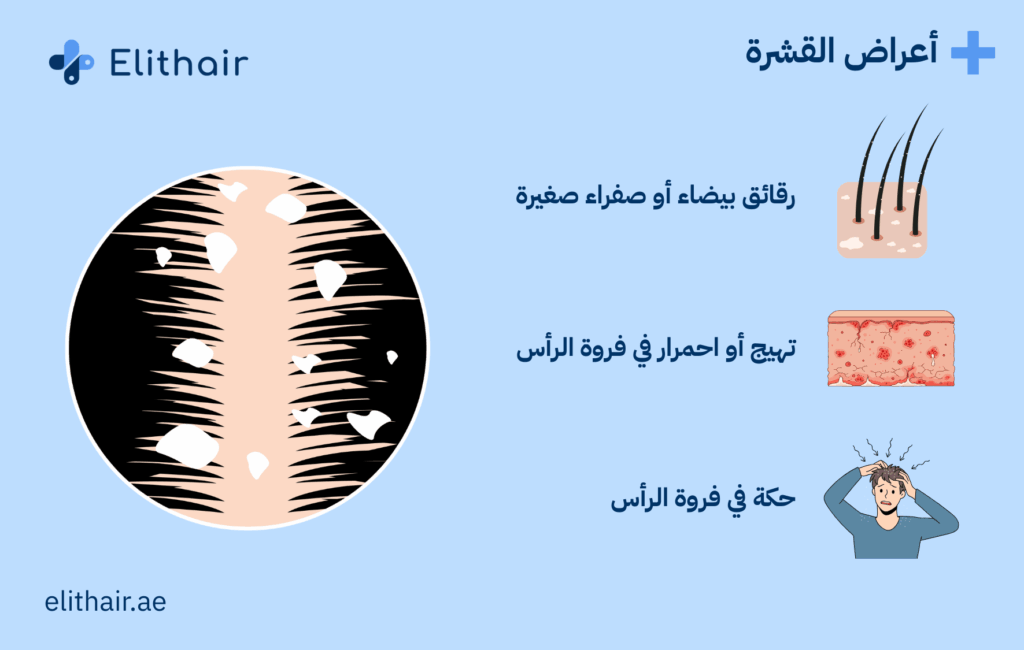 أعراض القشرة