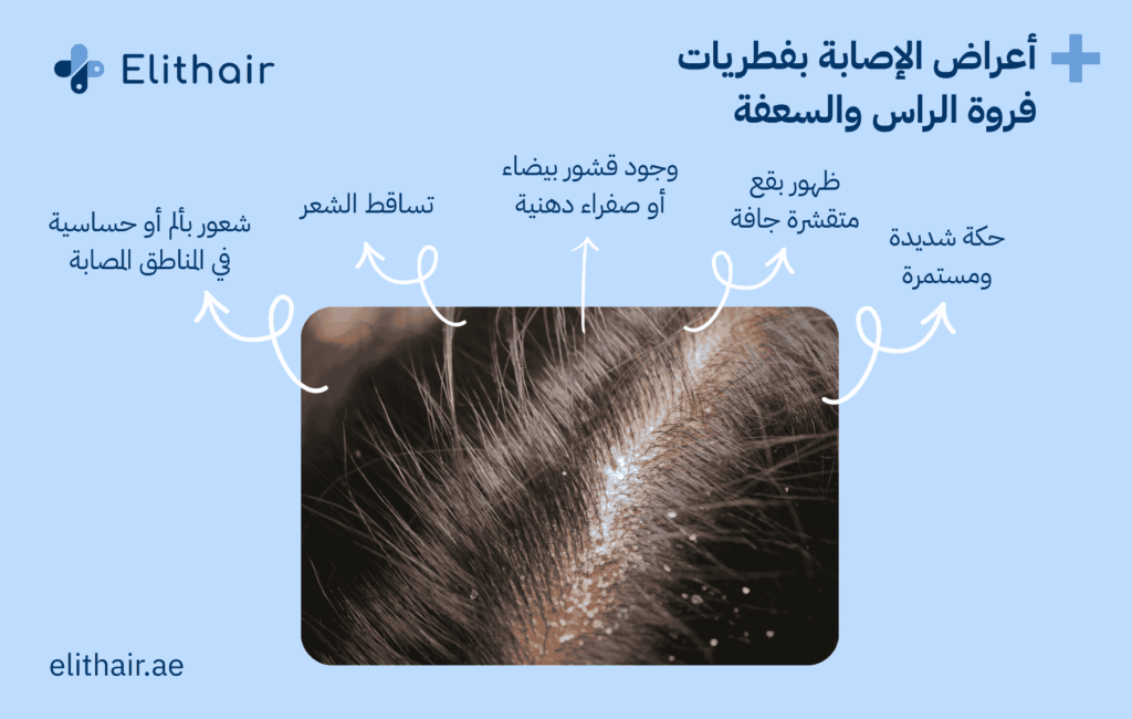 أعراض فطريات فروة الرأس - مركز اليت هير لزراعة الشعر