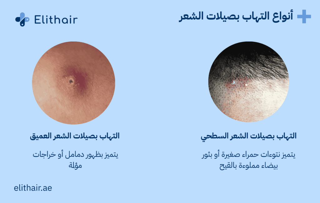أنواع التهاب بصيلات الشعر - مركز اليت هير لزراعة الشعر