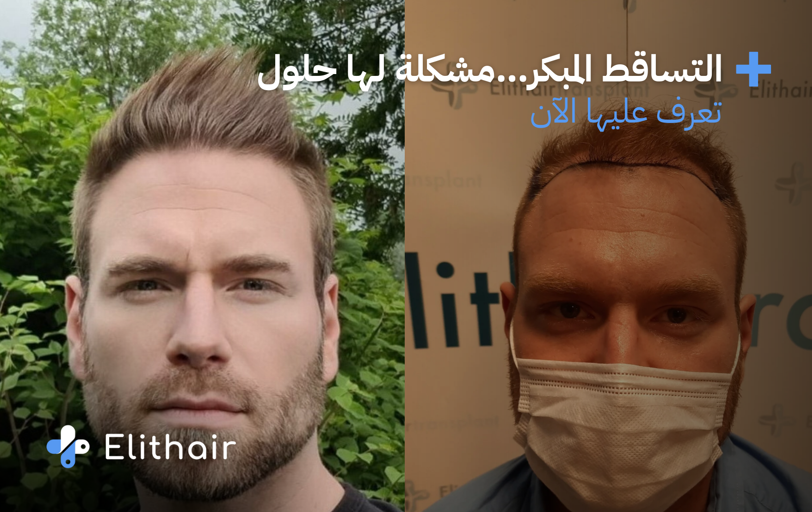 رجل قبل وبعد عملية زراعة الشعر كحل لتساقط الشعر المبكر عند الرجال