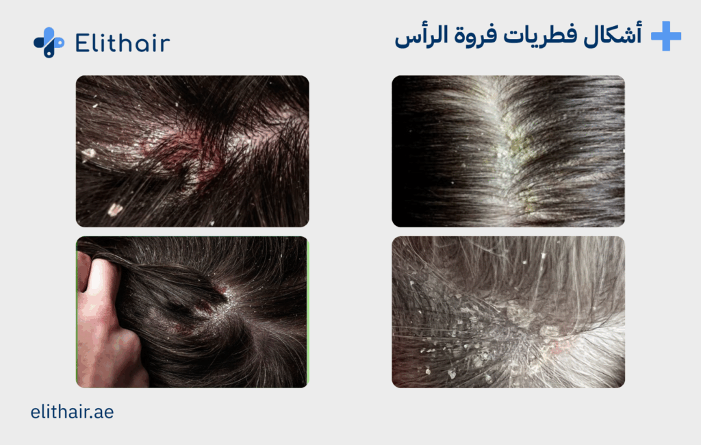 اشكال فطريات فروة الرأس - مركز اليت هير لزراعة الشعر