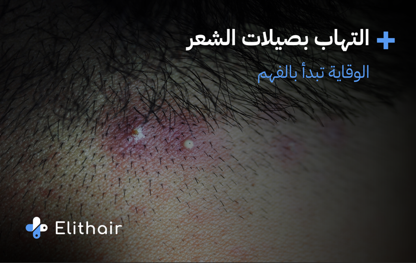 اسباب التهاب بصيلات الشعر وطرق الوقاية منها - مركز اليت هير لزراعة الشعر