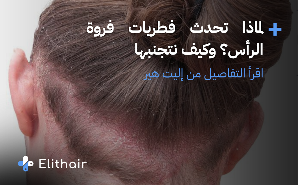 تظهر الصورة شخص مريض بفطريات فروة الرأس - مركز اليت هير لزراعة الشعر