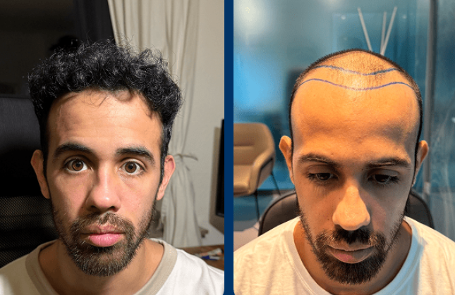 قبل وبعد زراعة  الشعر 