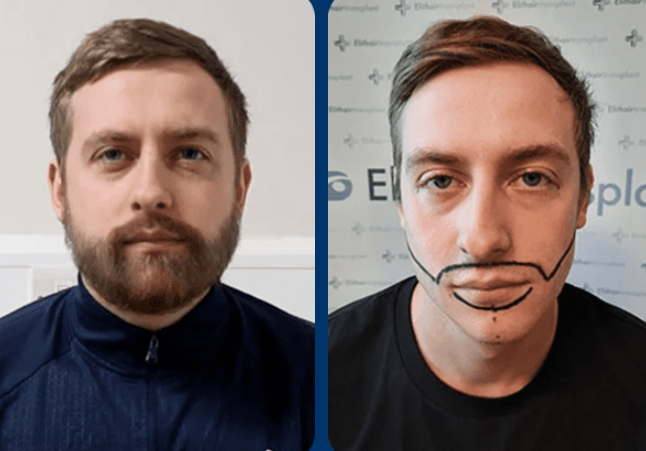 قبل وبعد زراعة اللحية