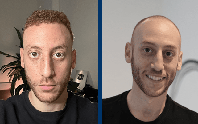 قبل و وبعد زراعة الشعر لليوتيوبر ضياء 