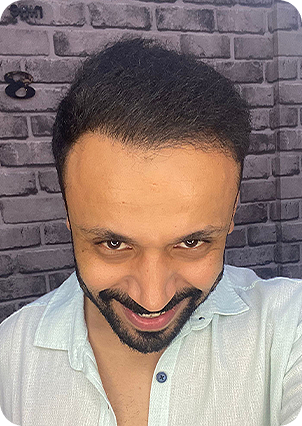 عبد الله شاهين بعد زراعة الشعر في إليت هير