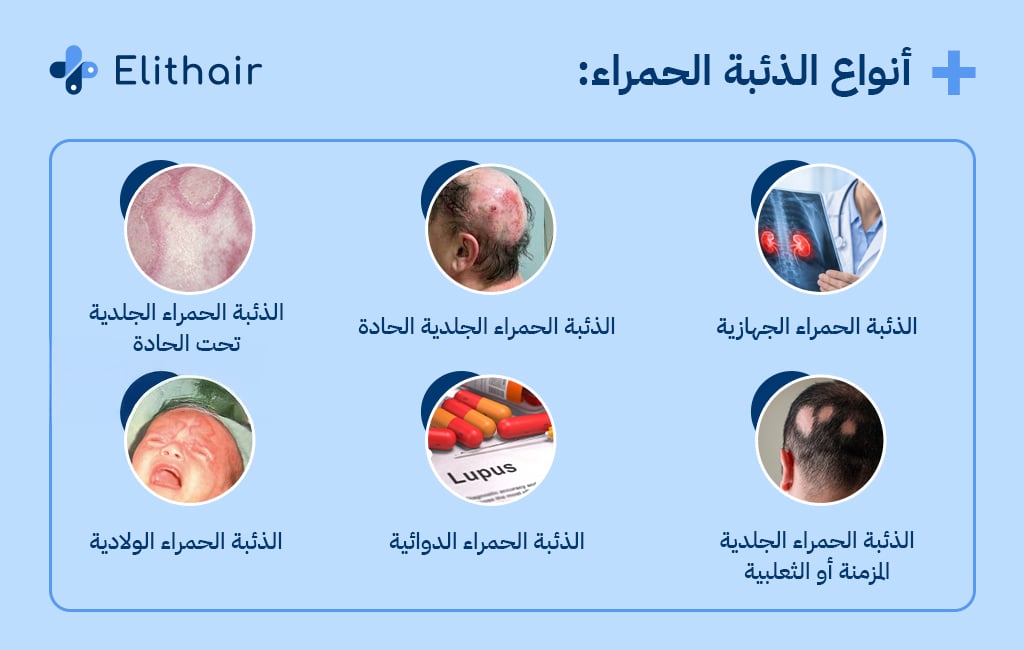 أنواع الذئبة الحمراء- مركز اليت هير لزراعة الشعر