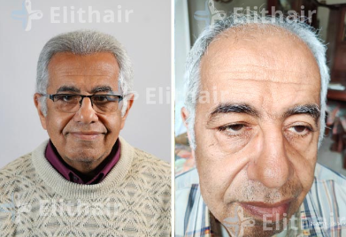 قبل وبعد زراعة الشعر 