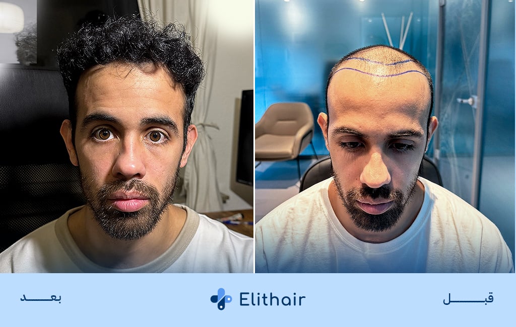 قبل وبعد زراعة الشعر