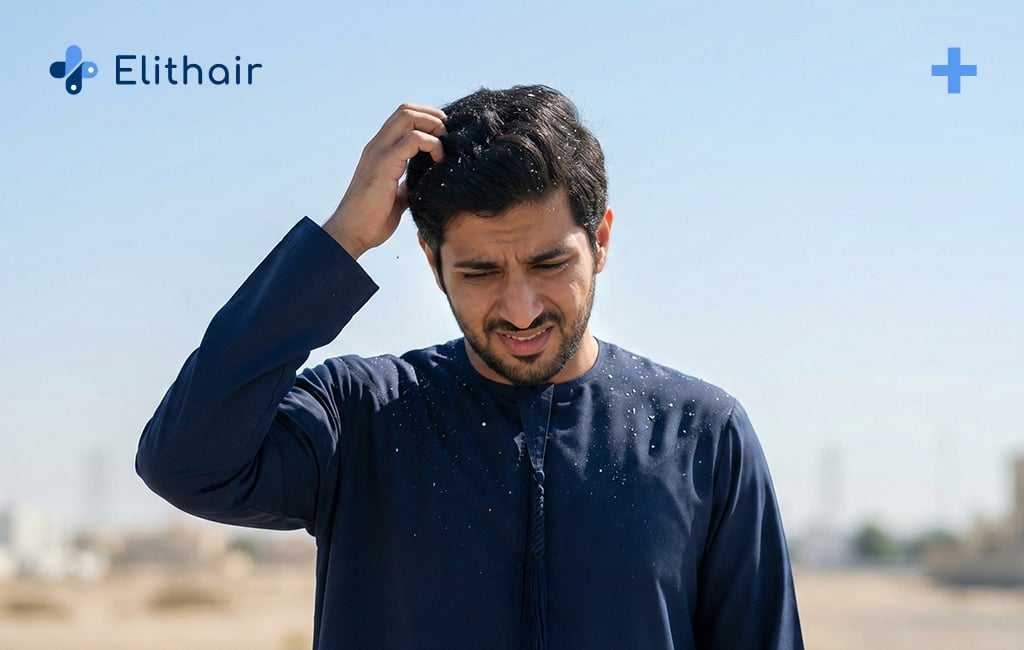 شخص خليجي يعاني من القشرة - مركز اليت هير لزراعة الشعر