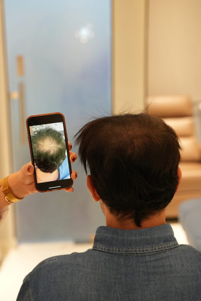 قبل وبعد تغطية فراغات الشعر بـ SMP