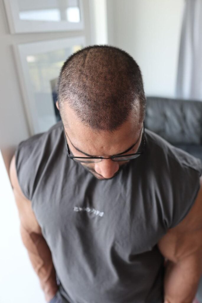 الشهر الأول بعد زراعة الشعر 