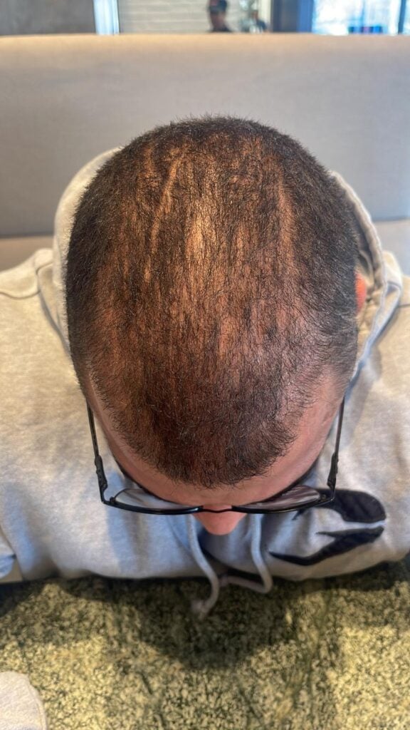 بعد ثلاث أشهر من زراعة الشعر 