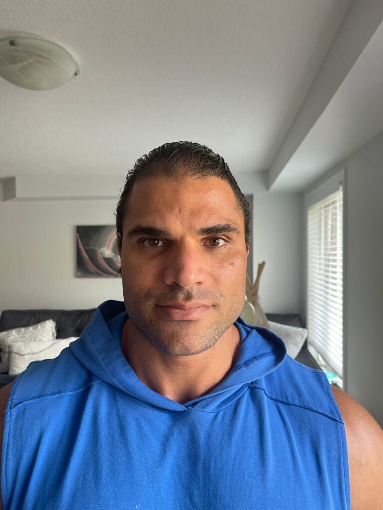 قبل زراعة الشعر في تركيا 