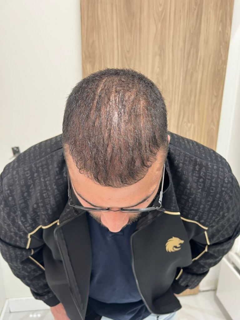 بعد ستة أشهر من زراعة الشعر 