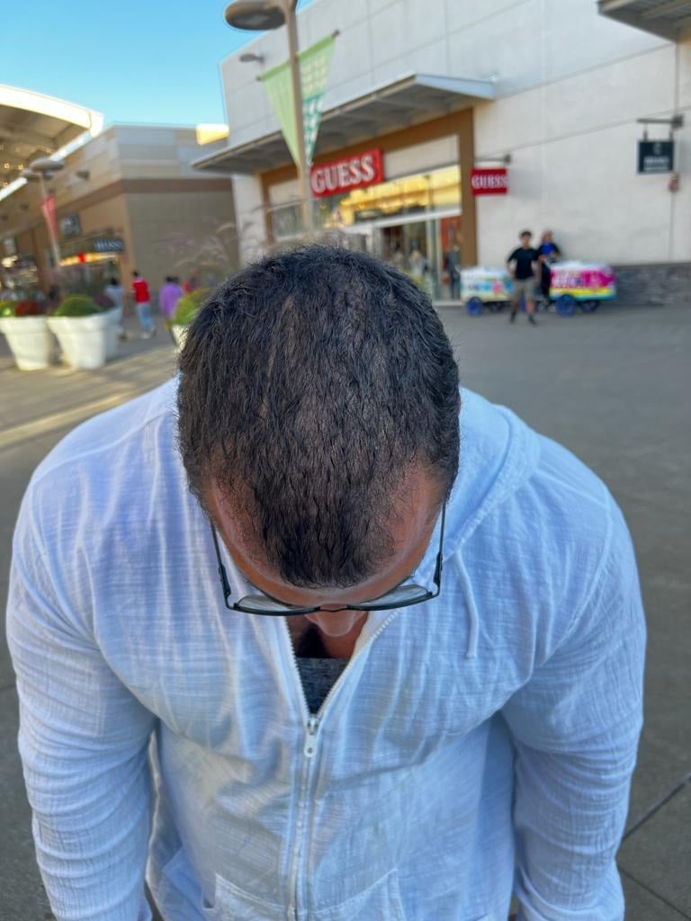 الشهر الثاني بعد زراعة الشعر 