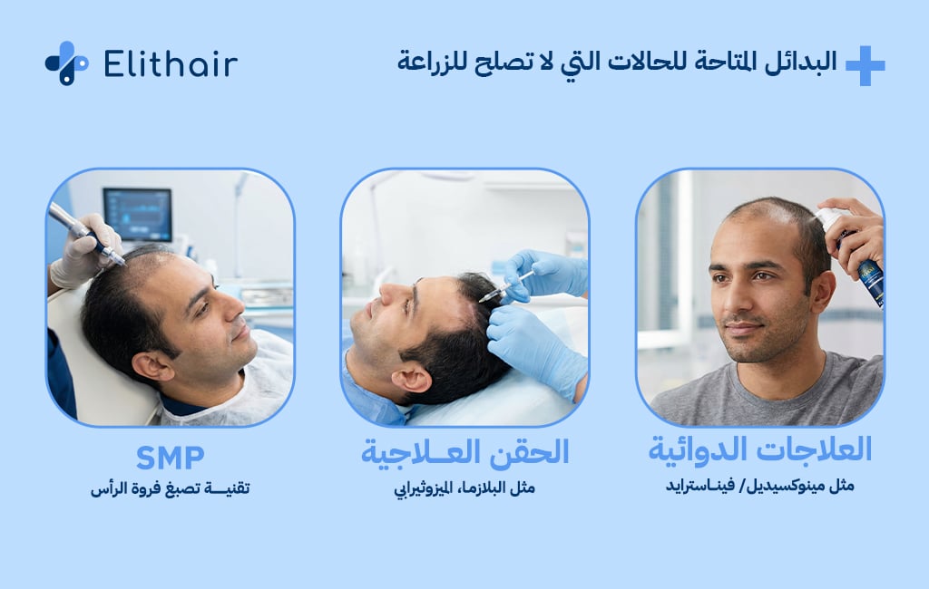 البدائل المتاحة للحالات التي لت تصلح لزراعة الشعر