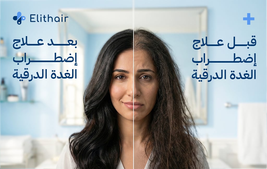 تأثير خلل الغدة الدرقية على الشعر - مركز اليت هير لزراعة الشعر