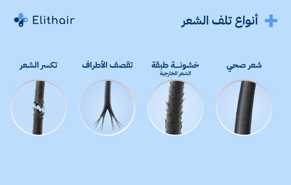 أنواع تلف الشعر - مركز اليت هير لزراعة الشعر